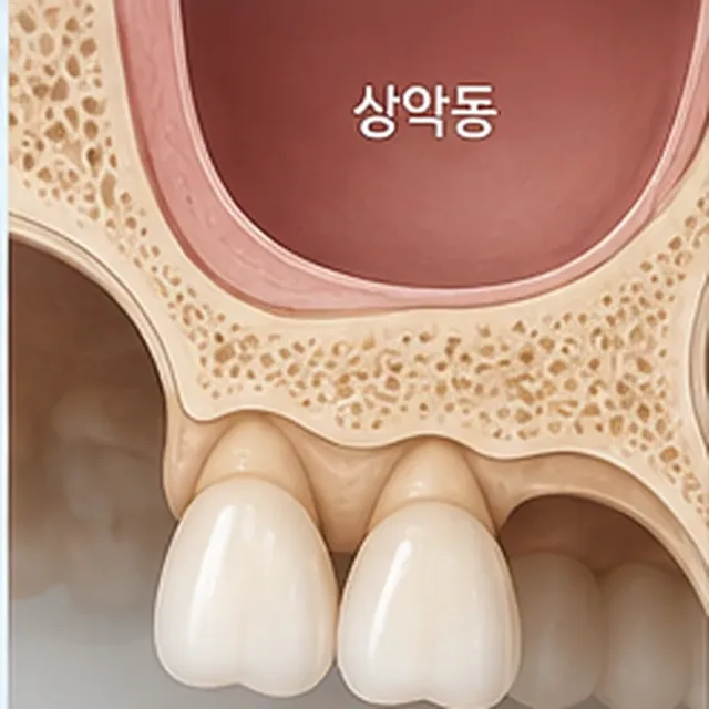 상악동이 내려와 있어 위턱 어금니 부위의 뼈 높이가 모자란 단면