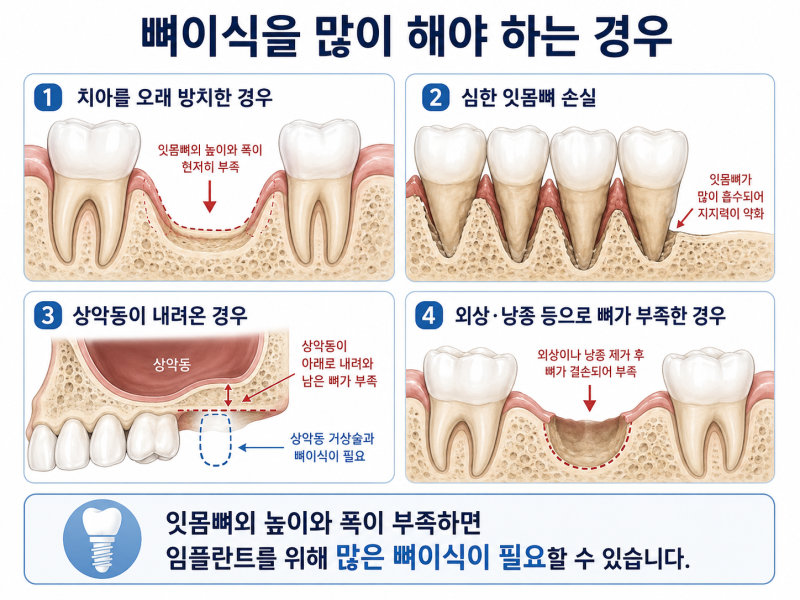 치아를 오래 방치한 경우, 심한 잇몸 손실, 상악동이 내려온 경우, 외상·낭종 등으로 뼈가 부족한 경우를 설명하는 뼈이식 필요 상황 인포그래픽