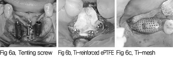 Tenting screw, Ti-reinforced ePTFE, Ti-mesh를 사용한 치과 임상 사진 3장
