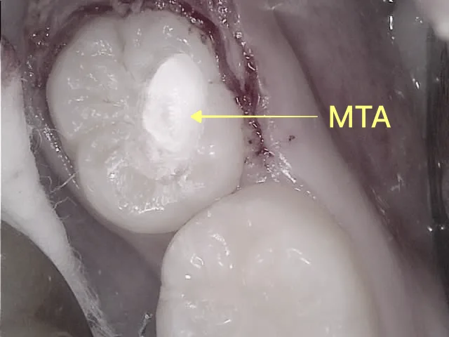 치아에 MTA 재료를 적용한 모습