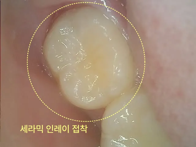 세라믹 인레이 접착 전 치아의 구강 내 사진