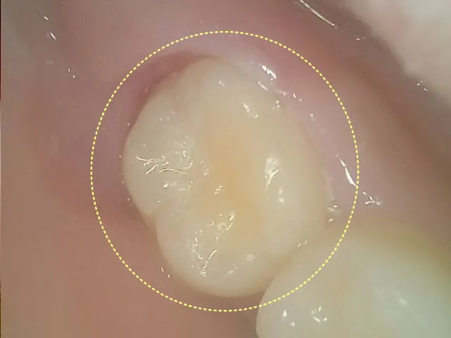 세라믹 인레이 접착 후 치아의 구강 내 사진