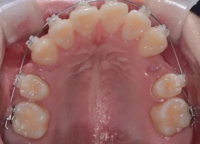 환자의 상악 구강 내 치아 교정 장치 부착된 모습