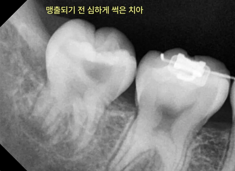 맹출되기 전 심하게 썩은 치아를 보여주는 방사선 사진