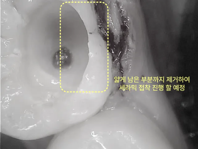 충치 제거 후 치아 내부 모습, 얇게 남은 부분 제거 예정