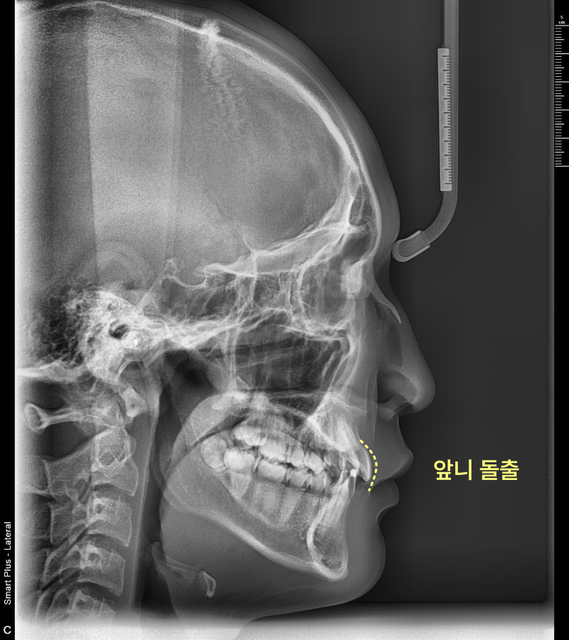 측면 두부 방사선 사진