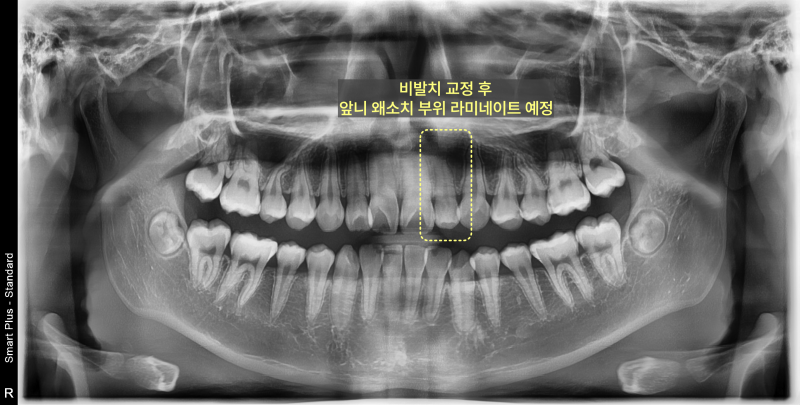 파노라마 방사선 사진