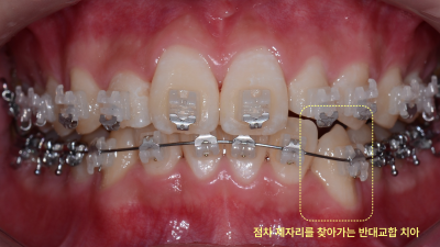 교정 장치를 부착한 치아 정면 구강 내 사진