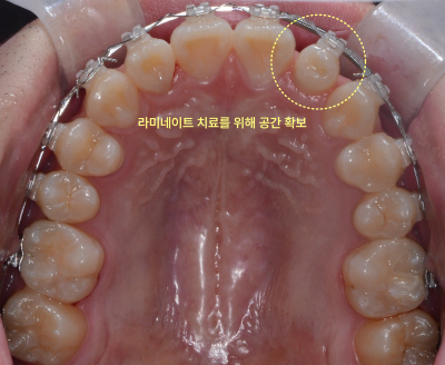 평택교정치과 발치 없이도 튀어나온 앞니 교정이 가능할까요? 관련 사진 22