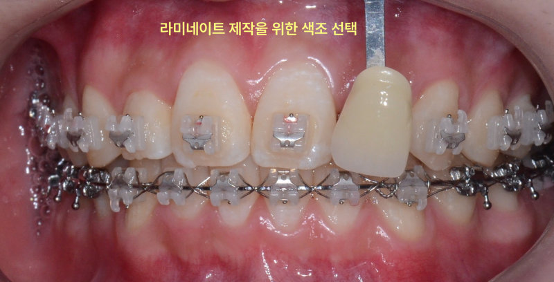 평택교정치과 발치 없이도 튀어나온 앞니 교정이 가능할까요? 관련 사진 25