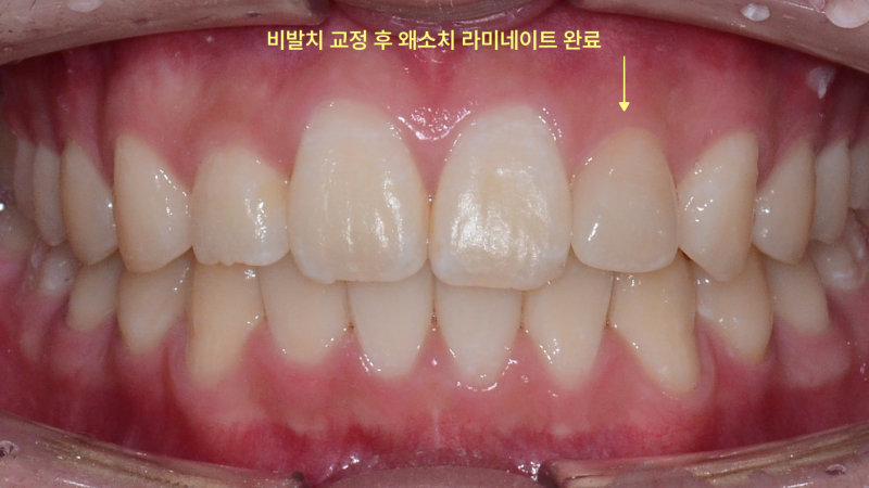 평택교정치과 발치 없이도 튀어나온 앞니 교정이 가능할까요? 관련 사진 26