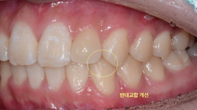 평택교정치과 발치 없이도 튀어나온 앞니 교정이 가능할까요? 관련 사진 28