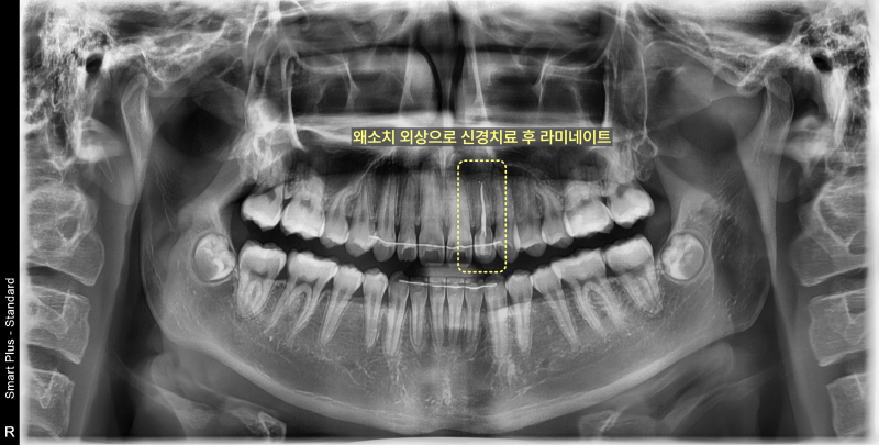 평택교정치과 발치 없이도 튀어나온 앞니 교정이 가능할까요? 관련 사진 31