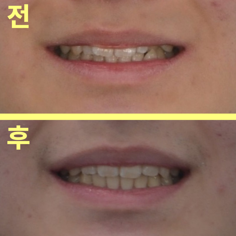 평택교정치과 발치 없이도 튀어나온 앞니 교정이 가능할까요? 관련 사진 32