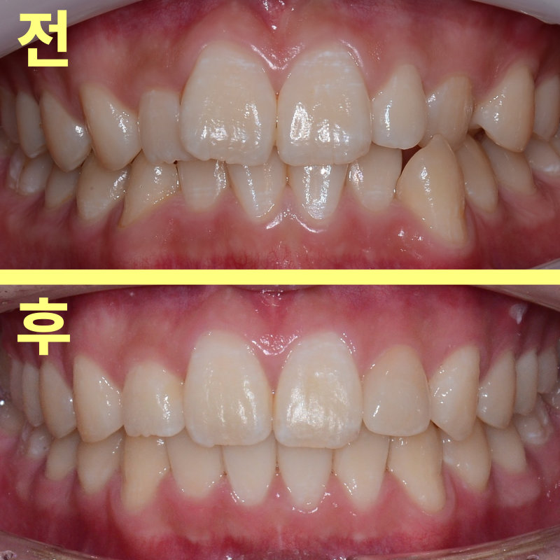 평택교정치과 발치 없이도 튀어나온 앞니 교정이 가능할까요? 관련 사진 33