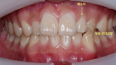 치아 정면 구강 내 사진