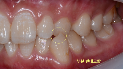 치아 좌측면 구강 내 사진
