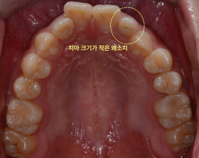 상악 치아의 구강 내면 사진