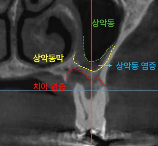 상악동, 상악동막, 상악동 염증, 치아 염증이 표시된 치과 CT 사진