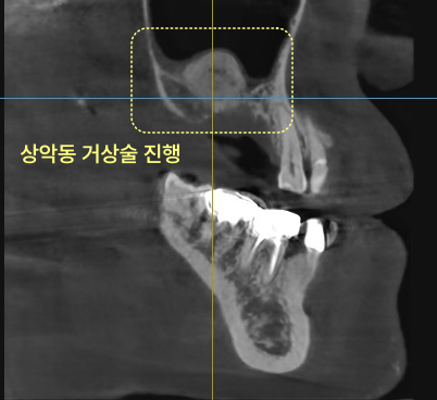 상악동 거상술 진행 부위가 노란색 점선 사각형으로 표시된 치과 CT 사진