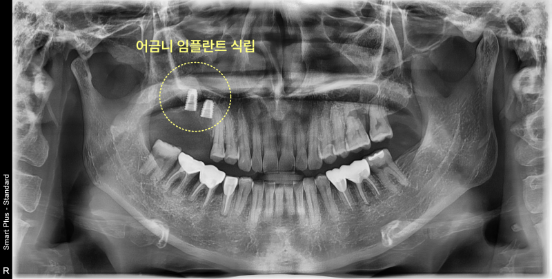 상악 우측 어금니 부위에 임플란트가 식립된 파노라마 방사선 사진