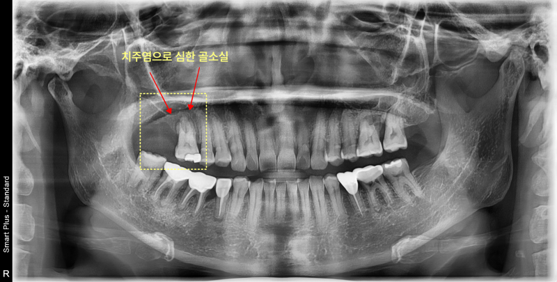 치주염으로 인한 심한 골손실이 노란색 점선 사각형으로 표시된 파노라마 방사선 사진