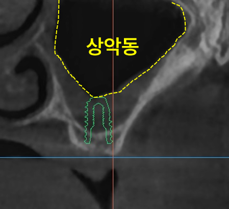 상악동과 임플란트 식립 위치가 표시된 치과 CT 사진