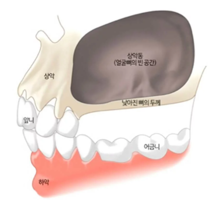 상악동과 얇아진 뼈의 두께를 설명하는 치과 해부학 일러스트