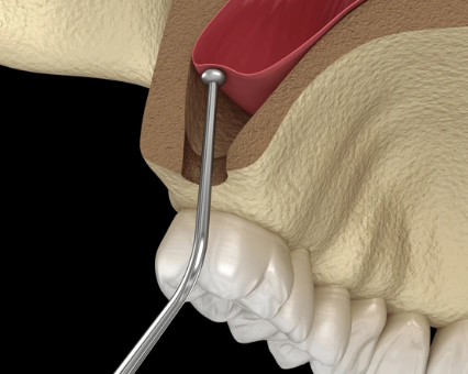 상악동 거상술 중 상악동막을 거상하는 과정을 보여주는 3D 일러스트