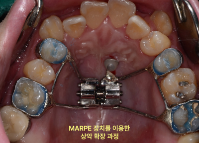 MARPE 장치를 이용한 상악 확장 과정 중인 환자의 상악 구강 내면 사진.