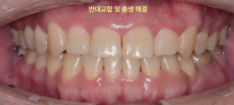 성인 환자의 정면 구강 내 사진. 반대교합과 충생이 해결된 모습이다.
