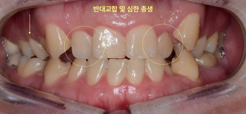 성인 환자의 정면 구강 내 사진. 반대교합과 심한 충생이 표시되어 있다.