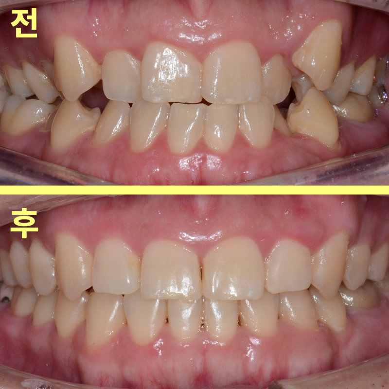 평택교정치과 성인 반대교합, 수술 없이 가능할까요? 관련 사진 23