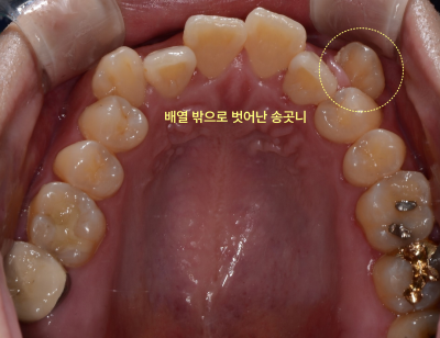 성인 환자의 상악 구강 내면 사진. 배열 밖으로 벗어난 송곳니가 표시되어 있다.