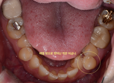 성인 환자의 하악 구강 내면 사진. 배열 밖으로 벗어난 작은 어금니가 표시되어 있다.