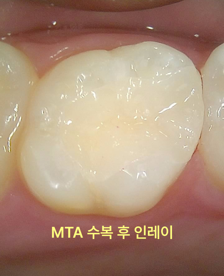 MTA 수복 후 인레이를 적용한 어금니의 임상 사진