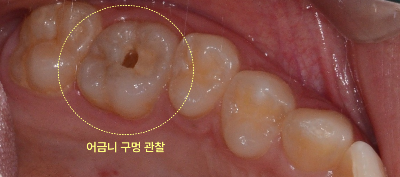 구강 내 어금니에 깊은 충치로 인한 구멍이 관찰되는 임상 사진