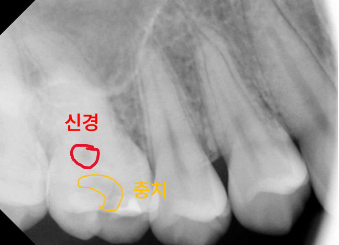 상악 우측 어금니 부위의 치과 방사선 사진에 신경과 충치 부위가 표시됨