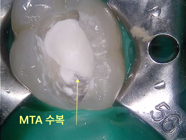 치아 내부 신경 부위에 MTA 재료로 수복한 임상 사진
