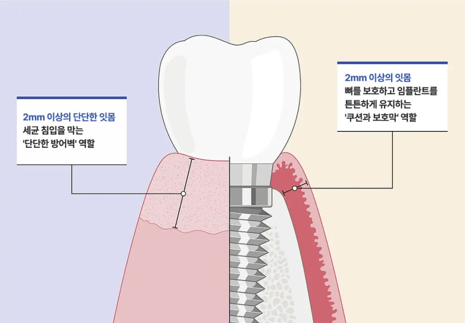 임플란트 주변 2mm 이상의 단단한 잇몸이 세균 침입을 막고 잇몸뼈를 보호하는 역할 설명 그림