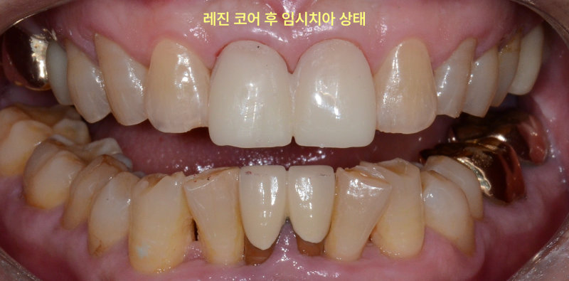 레진 코어 후 임시치아를 장착한 구강 내 정면 사진