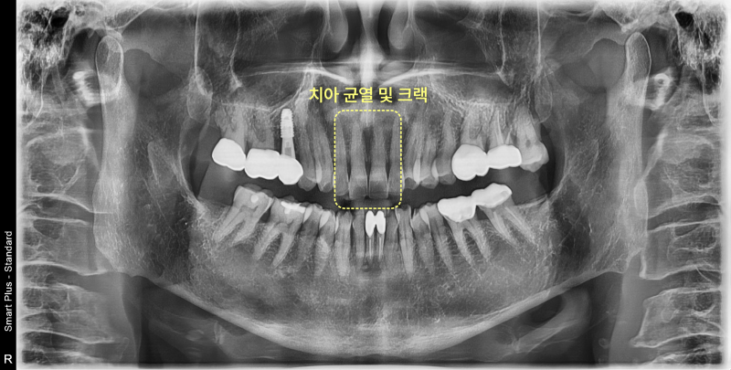 치아 균열 및 크랙이 노란색 점선 사각형으로 표시된 파노라마 방사선 사진