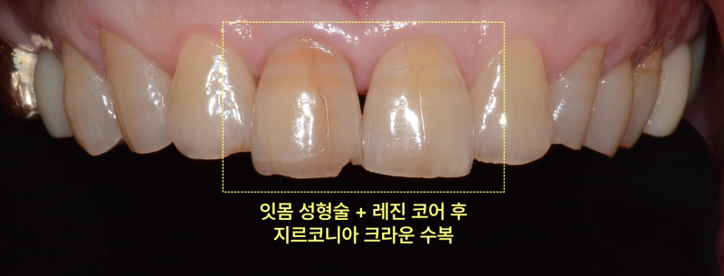 잇몸 성형 및 레진 코어 후 지르코니아 크라운 수복을 설명하는 구강 내 근접 사진