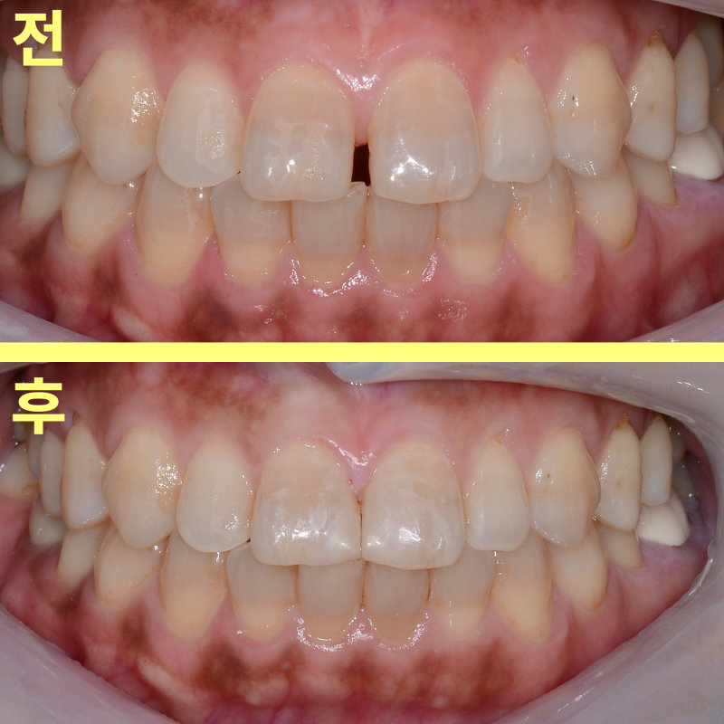 레진 치료 전후 벌어진 아래 앞니를 비교하는 사진, 위는 '전', 아래는 '후'로 표시됨
