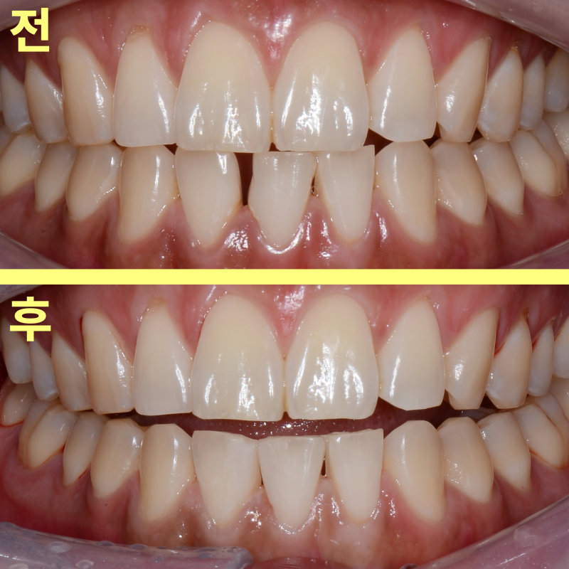 레진 치료 전후 벌어진 아래 앞니를 비교하는 사진, 위는 '전', 아래는 '후'로 표시됨