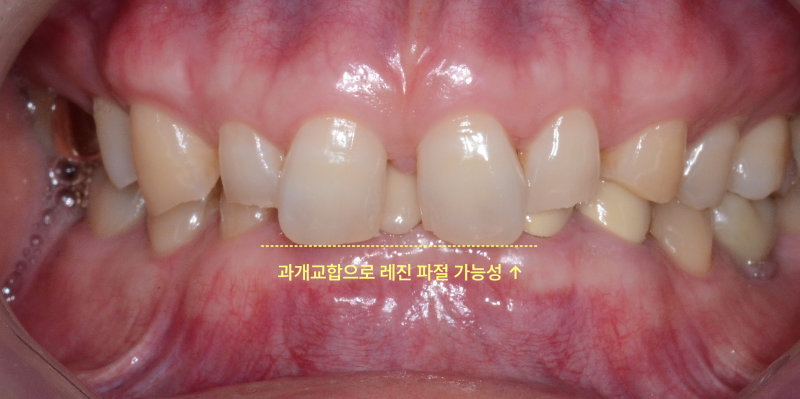 벌어진 위 앞니를 포함한 위아래 치아 전체를 정면에서 찍은 사진, '과개교합으로 레진 파절 가능성' 문구 표시