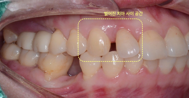 상악 전치부 우측면 구강 내 사진, 벌어진 치아 사이 공간 노란색 점선 표시