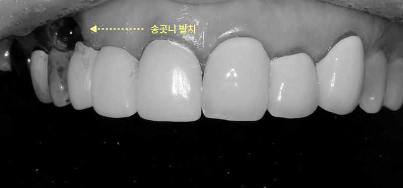 평택비전동치과 앞니 브릿지 충치, 전체 제거가 필요한 이유 관련 사진 10