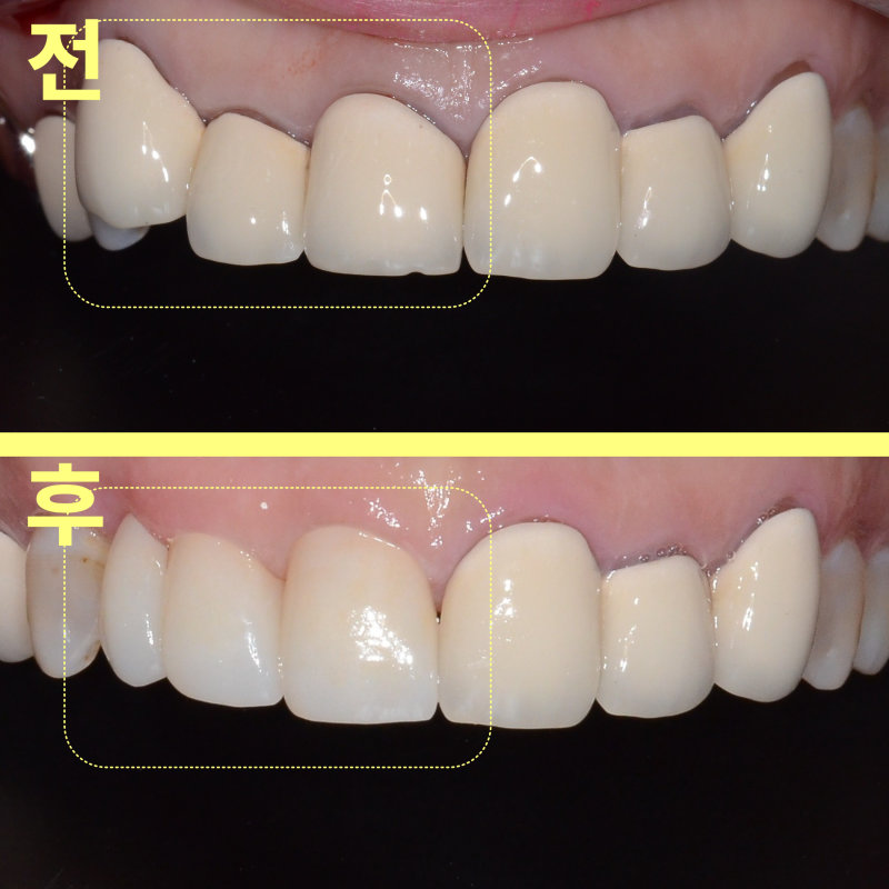평택비전동치과 앞니 브릿지 충치, 전체 제거가 필요한 이유 관련 사진 16