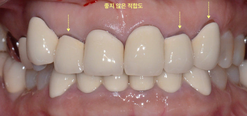 평택비전동치과 앞니 브릿지 충치, 전체 제거가 필요한 이유 관련 사진 6